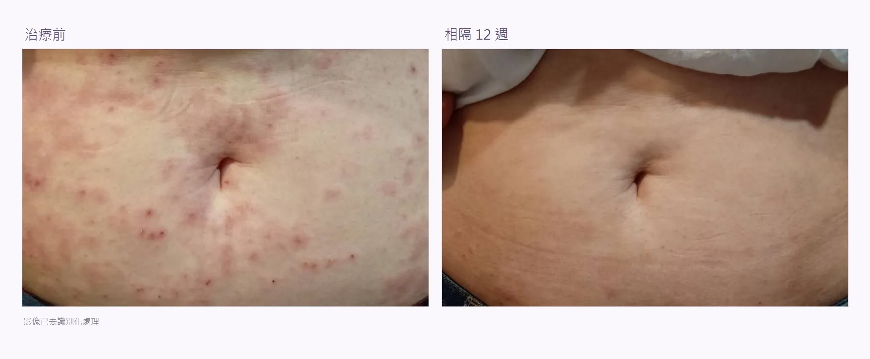 腹部皮膚治療前後對照:左為初診時,大量紅色丘疹與斑疹散布於腹部;右為相隔十二週後,皮膚平整、看不到明顯疹子