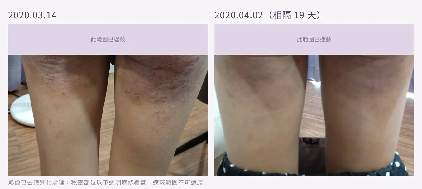 大腿後側皮膚治療前後對照:左為病灶活動期,皮膚粗糙、色澤暗紅並有明顯抓痕與丘疹;右為相隔十九天後,表面平整,僅餘色素沉著