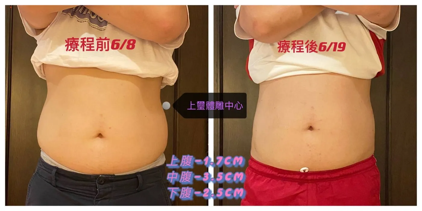 腹部療程前後對比:療程前 6/8 與療程後 6/19,上腹減少 1.7 公分、中腹減少 3.5 公分、下腹減少 2.5 公分
